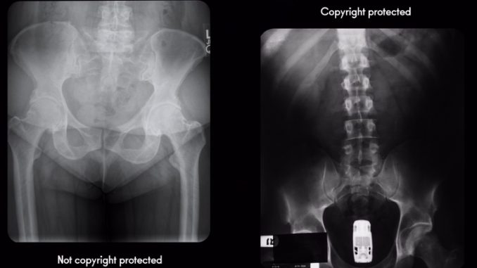 Butt X-ray